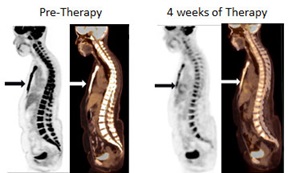 Measuring bone metastasis early response to therapy using FDG PET/CT